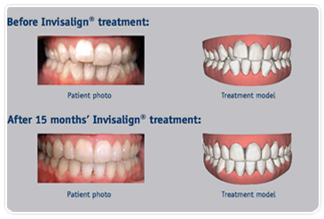 invisalign_box_B.png